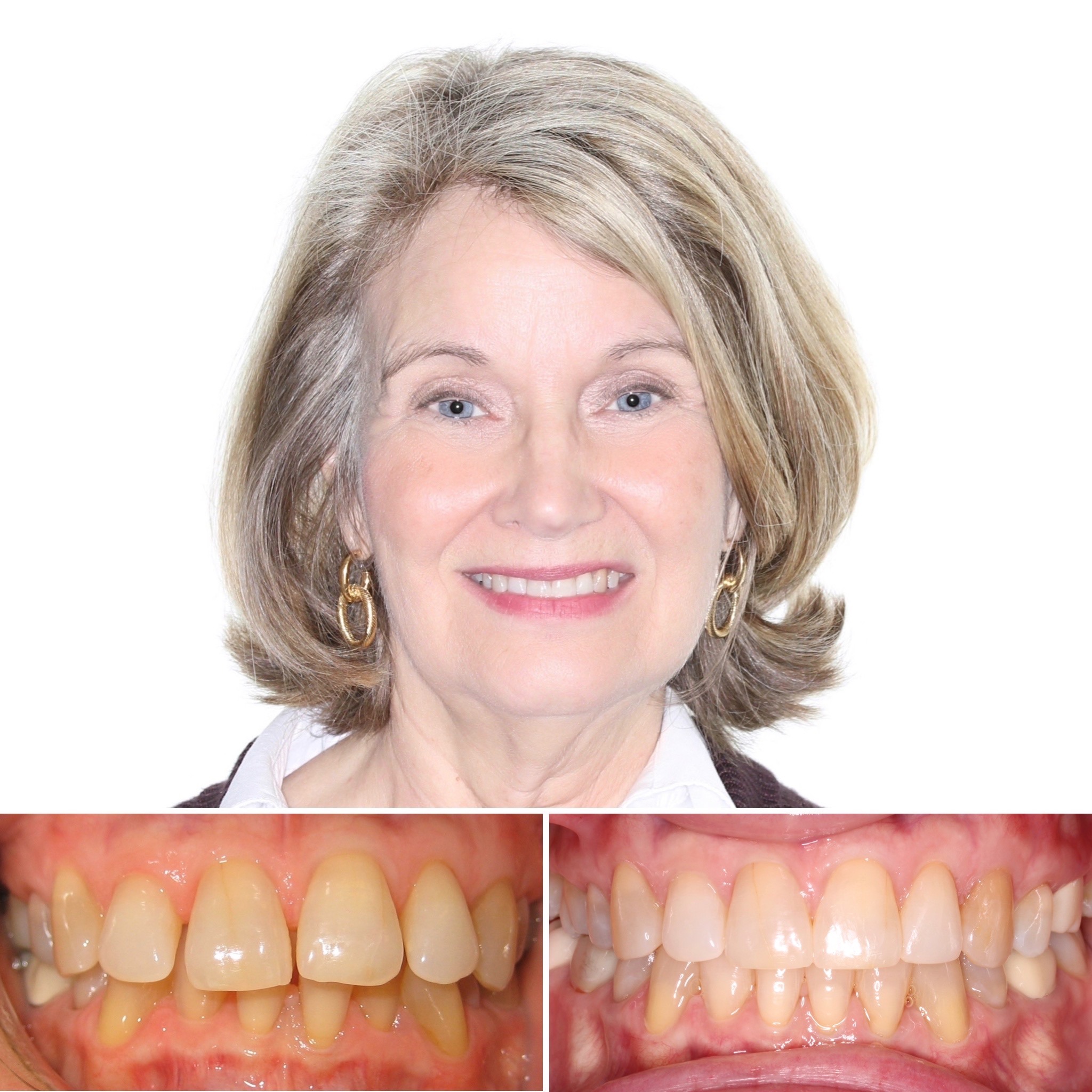 patient Nancy before and after photo