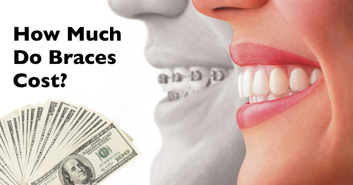 How much do braces cost? | How expensive is orthodontics? | Cost of Braces in Memphis, TN