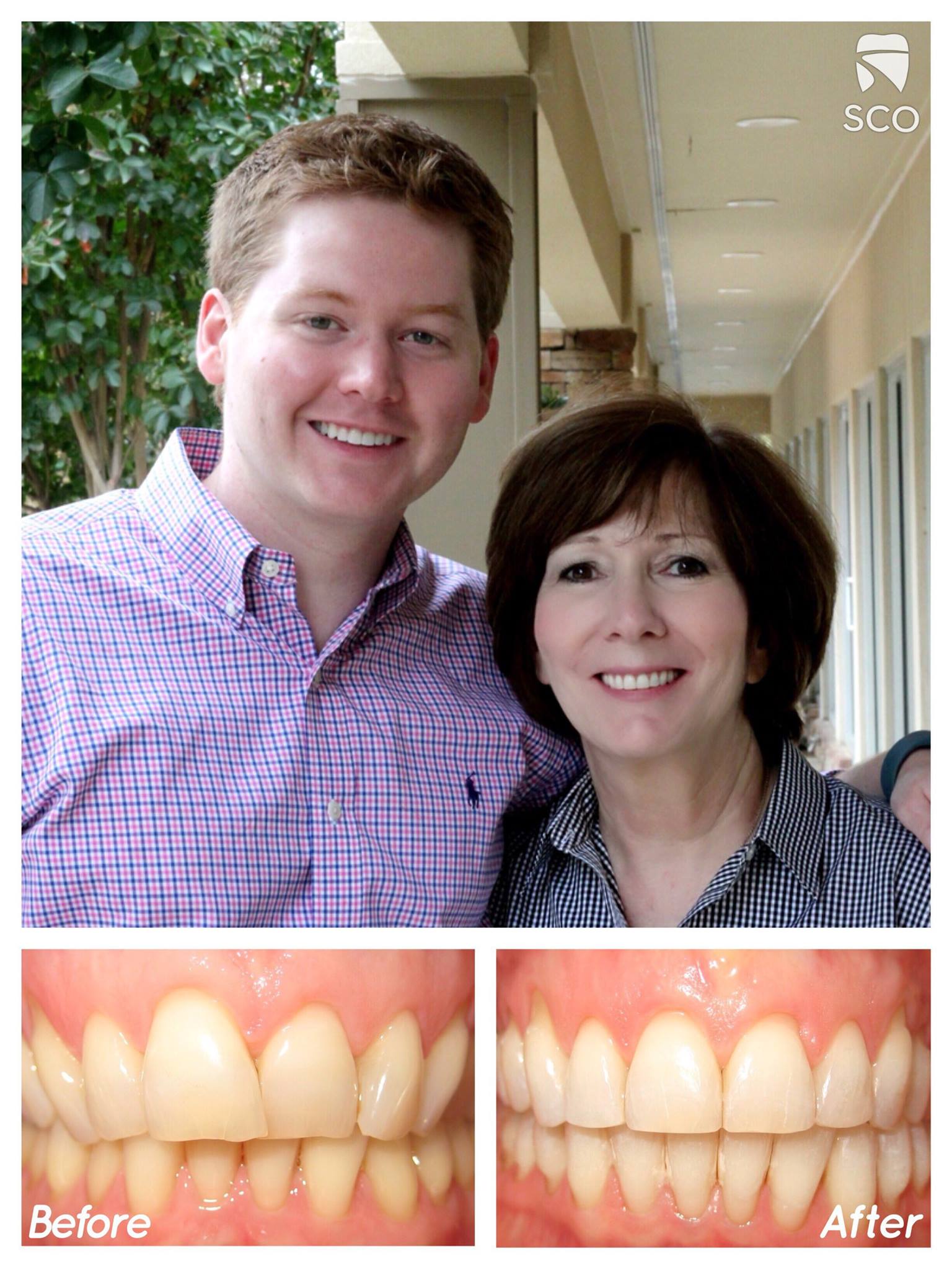 adult braces before and after | memphis orthodontist | Dr. Kyle Fagala