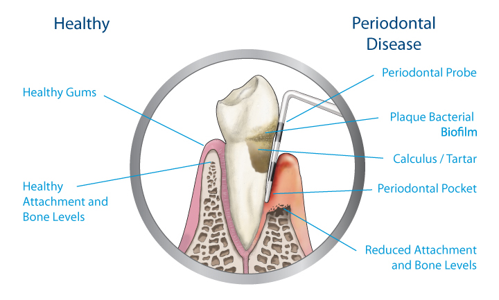 Periodontal Disease | Saddle Creek Orthodontics