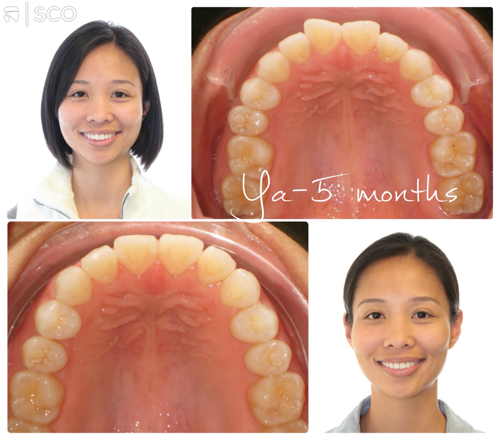Invisalign Memphis | Invisalign Before and After | Ya Before and After Invisalign