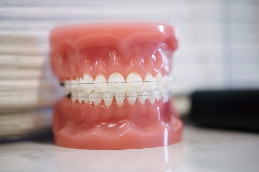 clear braces