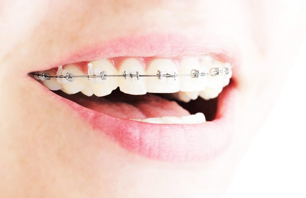 clear braces