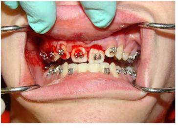 Tooth damage following sports accident while wearing braces | Sports Mouthguard | Braces Mouthguard