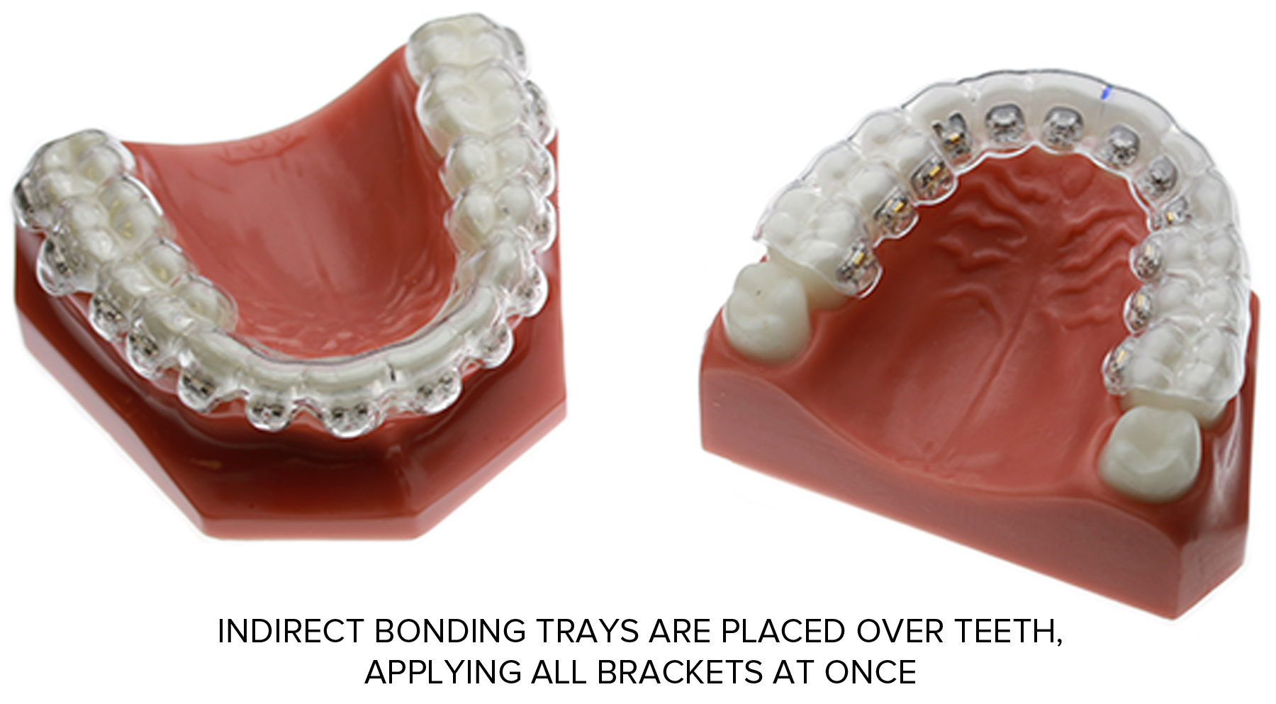 indirect bonding | orthodontic installation | Saddle Creek Orthodontics