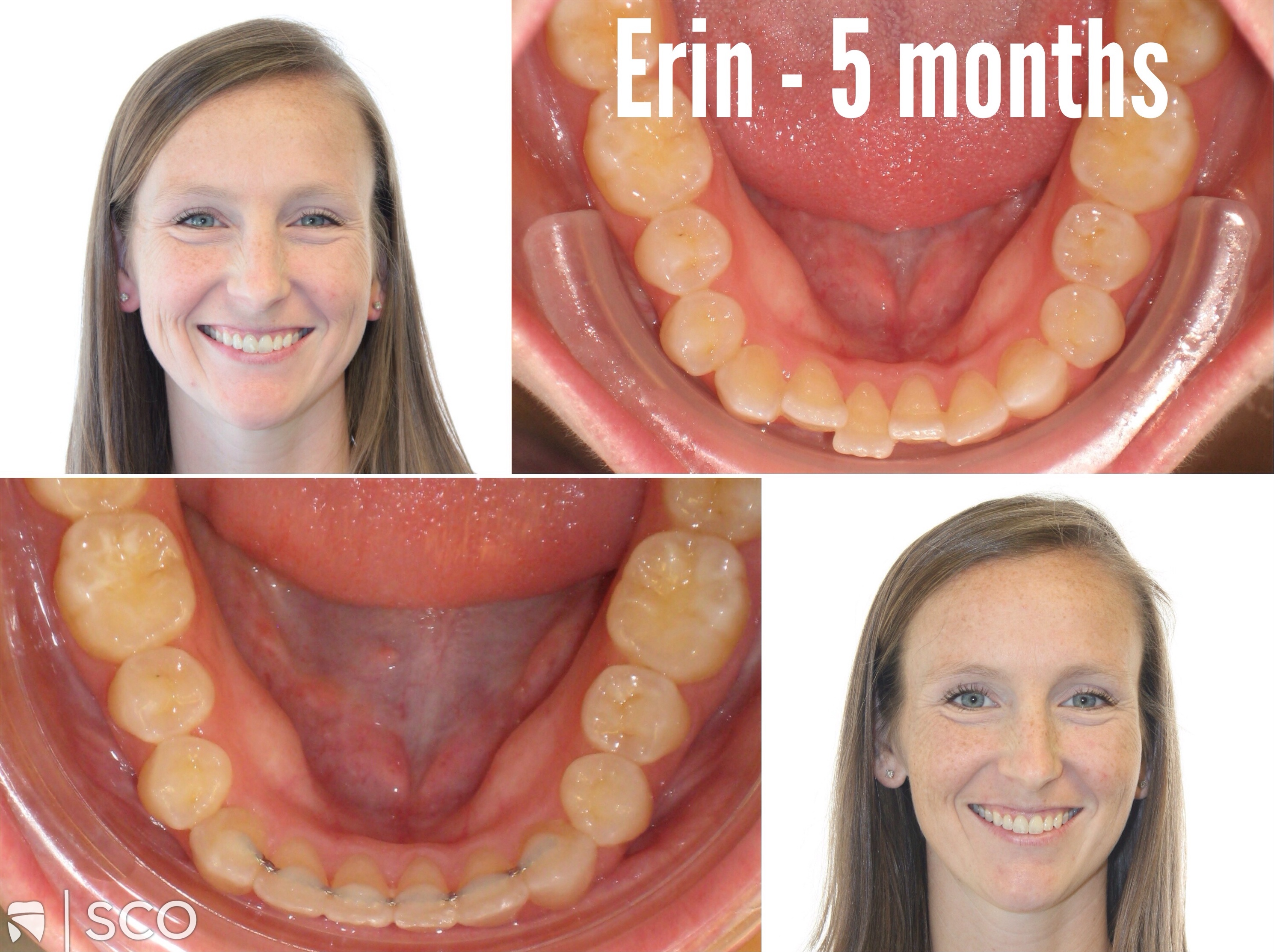 Invisalign Before and After | Patient Before and After Invisalign | Memphis Invisalign