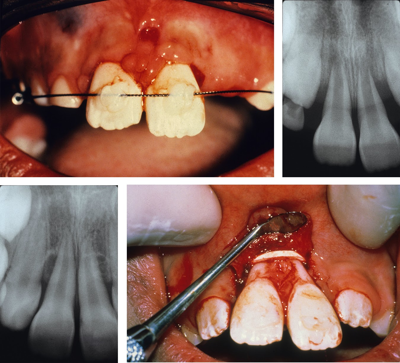 Gap Bands harm gum tissue | DIY Orthodontics | Photo Source: AJODO BLOG