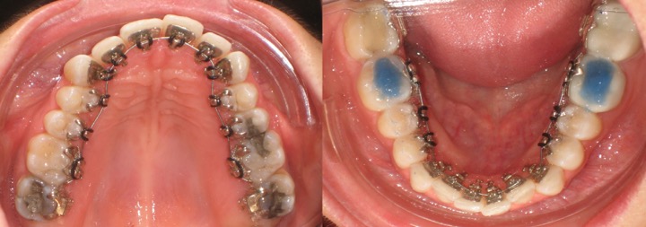 lingual braces | adult braces | saddle creek orthodontics
