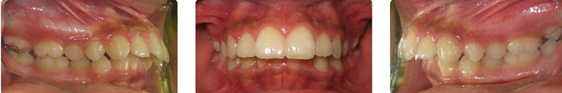 Tooth Photos | Protruding Teeth | Big Overbite