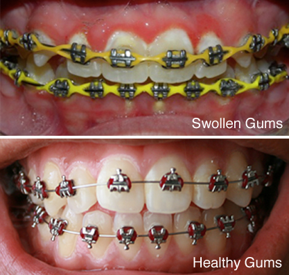Swollen Gums and Braces | Orthodontic swollen gums | Puffy gums with Braces