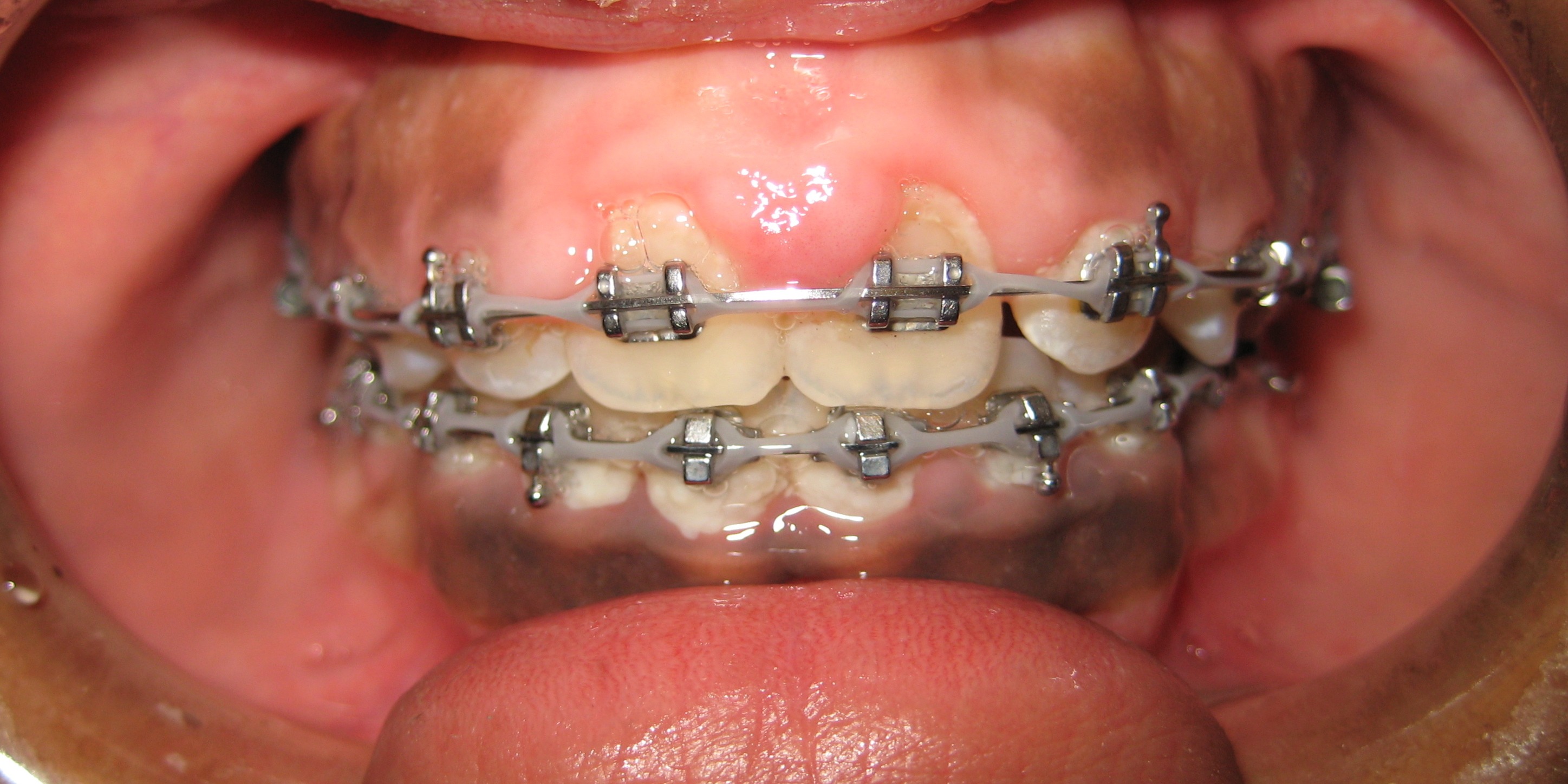 unhealthy gums with braces