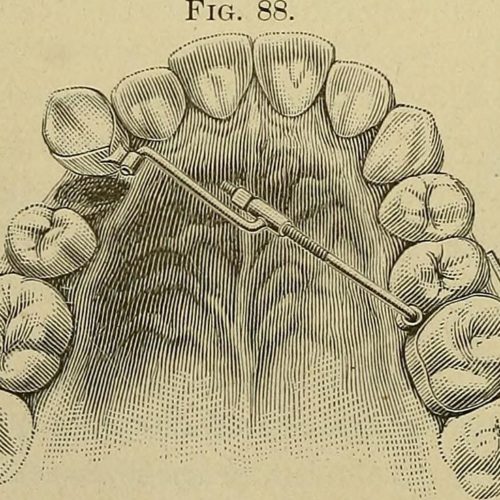 The History Of Braces